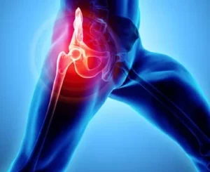 Myofascial Pain Hip Joint